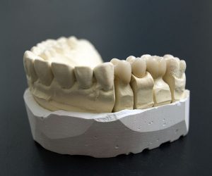 Zahnersatz in der Zahnarztpraxis dentteam in Köln